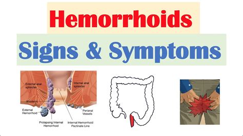 hemorrhoid in women.